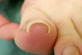 代表的な巻き爪矯正の症例1