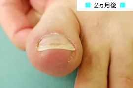 代表的な巻き爪矯正の症例1 後