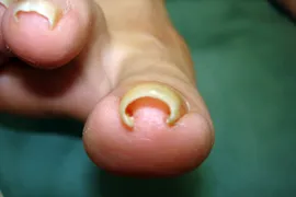 代表的な巻き爪矯正の症例3