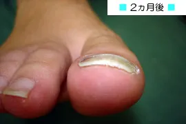 代表的な巻き爪矯正の症例3 後